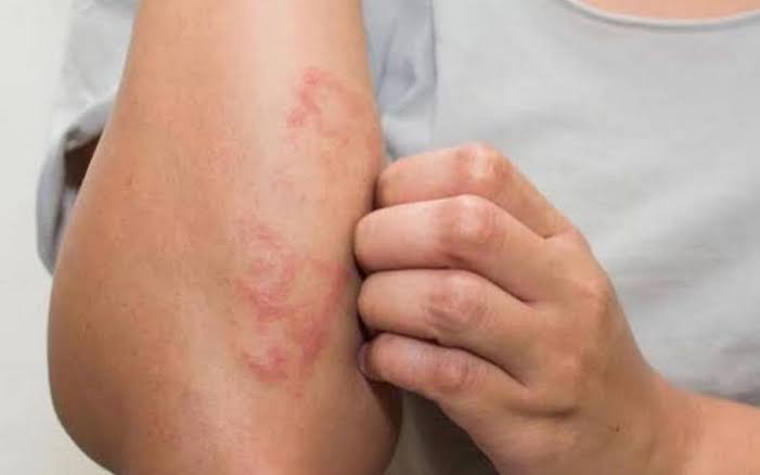 Lepra en República Dominicana: casos activos, señales de alerta y medidas sanitarias