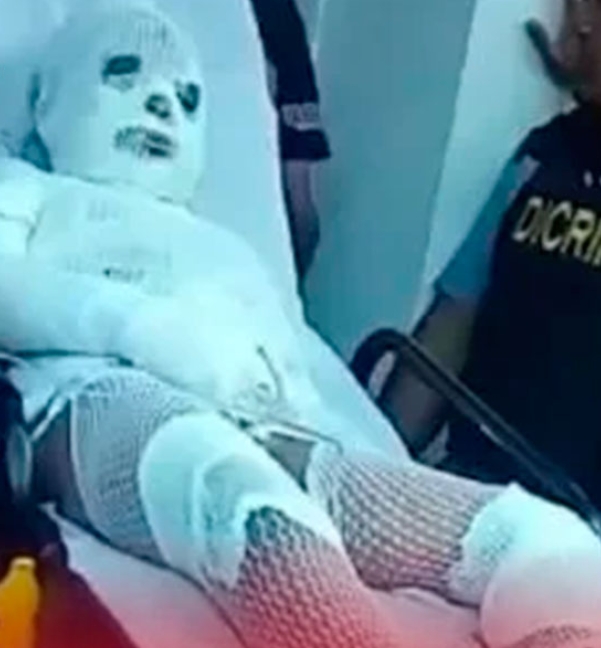 PN investiga caso de hombre incendiado por su hermano en Santiago